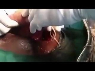 Bağırsak Kurdu Ameliyatı Riskleri ve Sonrası